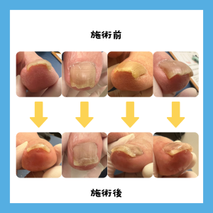 巻き爪患者さんの声